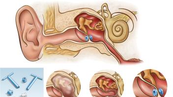 Ear Tubes