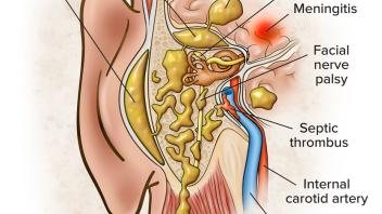 Acute Mastoiditis Illustration